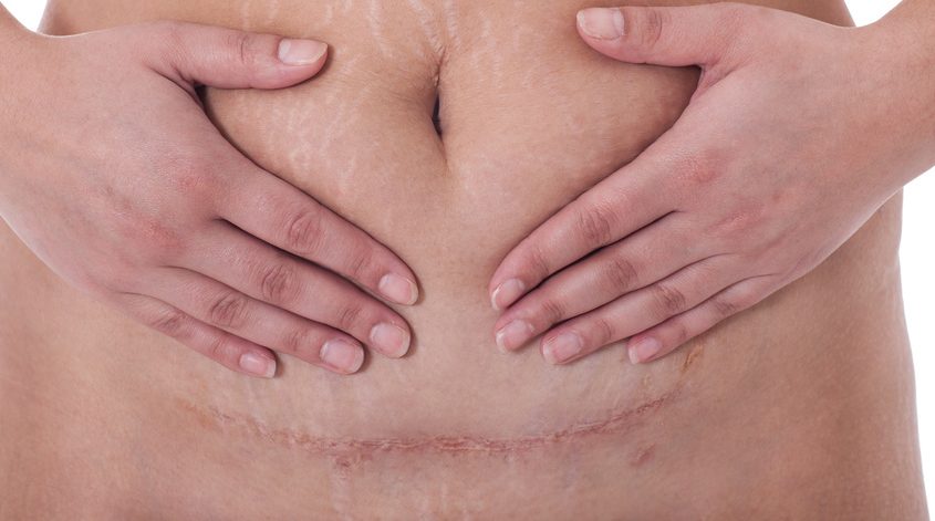 c-section scar massage